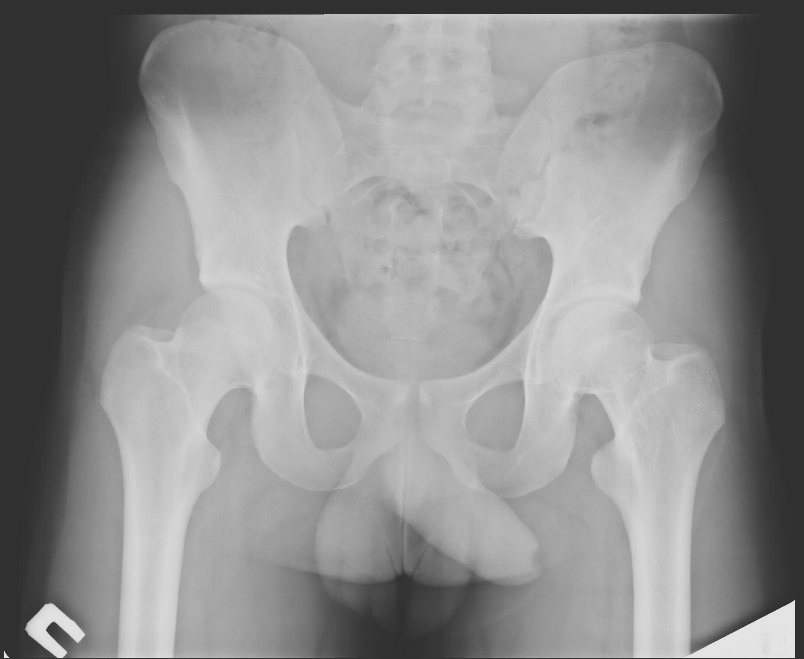 Шейка бедра у мужчин. Рентген таза перелом шейки бедра. Перелом шейки бедра рентген. Рентген таза перелом тазобедренного сустава. Перелом шейки тазобедренного сустава рентген.