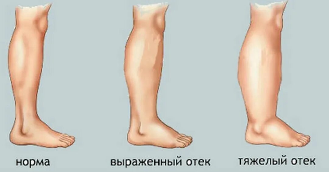 Отекшие ноги у беременных. Отеки ног классификация. Отеки на 35 неделе