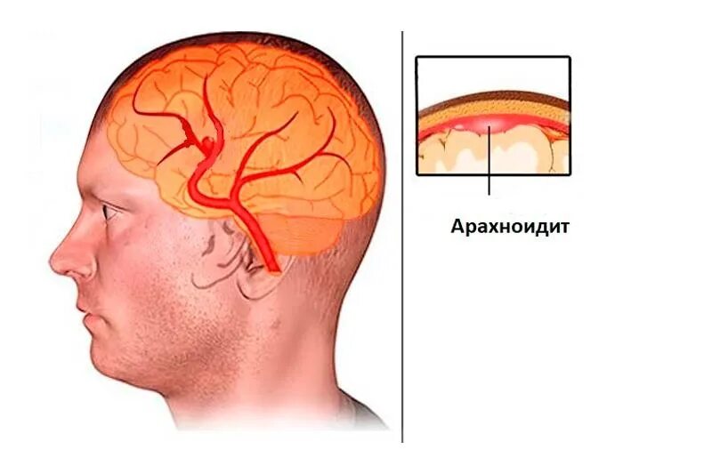 Гнойный мозг. Отогенный арахноидит. Воспаление паутинной оболочки головного мозга. Базилярный арахноидит. Арахноидальная киста нейросонография.