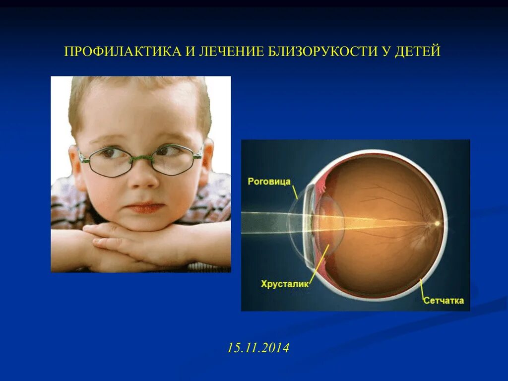 Миопия у ребенка форум. Близорукость. Миопия у детей дошкольного возраста. Миопия это в офтальмологии. Презентация на тему миопия.