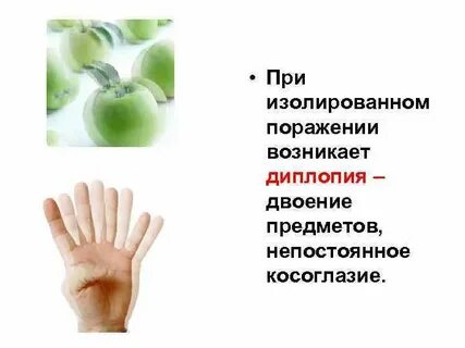 Диплопия