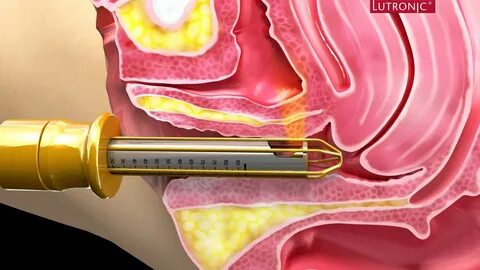 Лечение лазером матку 