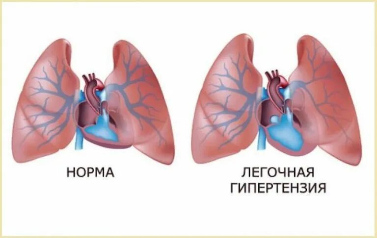 Идиопатическая легочная гипертензия. Первичная легочная гипертензия. Первичная легочная гипертония. Первичная легочная гипертензия у детей.