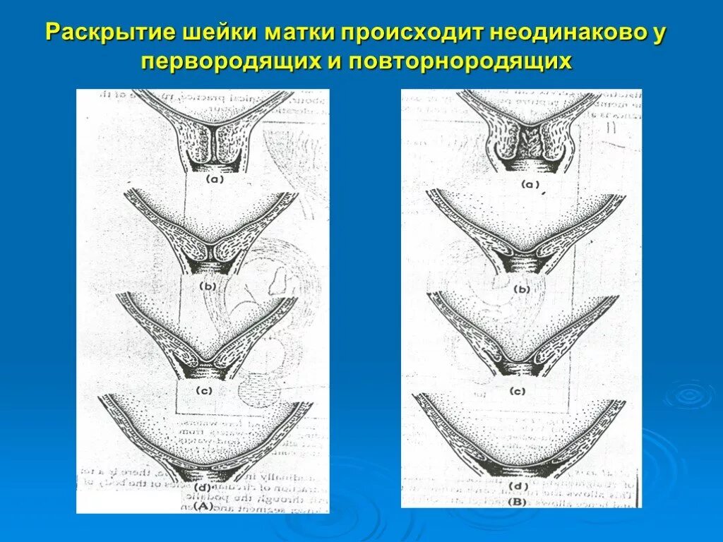 Раскрытие 2 пальца через сколько роды. Раскрытие шейки матки на 2 пальца. Раскрытие шейной матки. Раскрытие шейки матки в родах. Раскрытие матки у первородящей и повторнородящей.