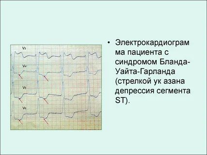 Синдром бланда уайта
