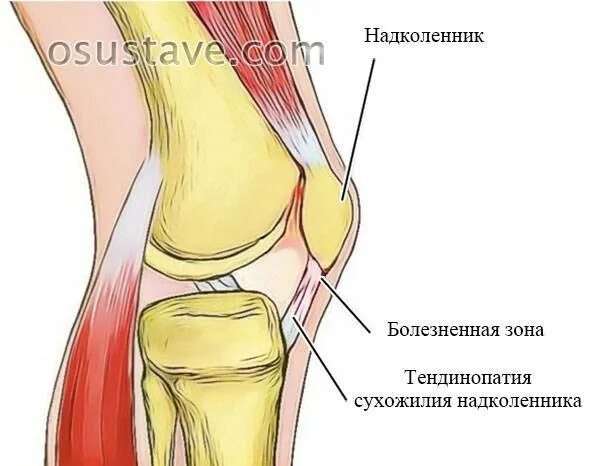 Тендиноз связок коленного сустава. Тендиноз собственной связи надколенника. Связки надколенника анатомия. Воспаление сухожилия колена. Тендинит связки надколенника.