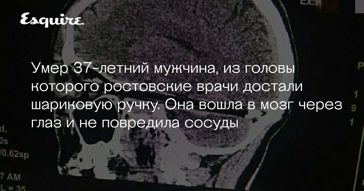 В мозг через глаза. Картина врач извлекает из головы камень.