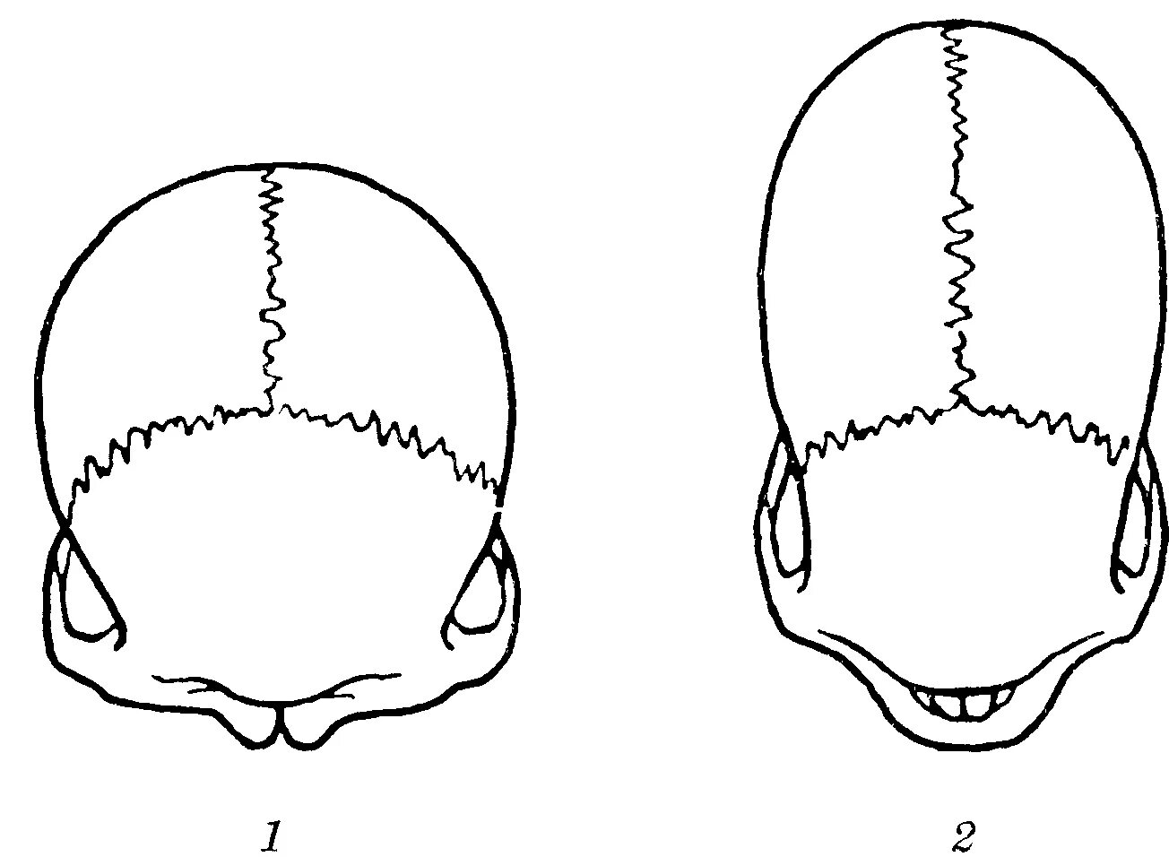 Варианты формы черепа. Долихоцефалическая форма чере. Мезоцефалия долихоцефалия. Формы головы у новорожденных долихоцефалия. Брахицефалия и долихоцефалия.