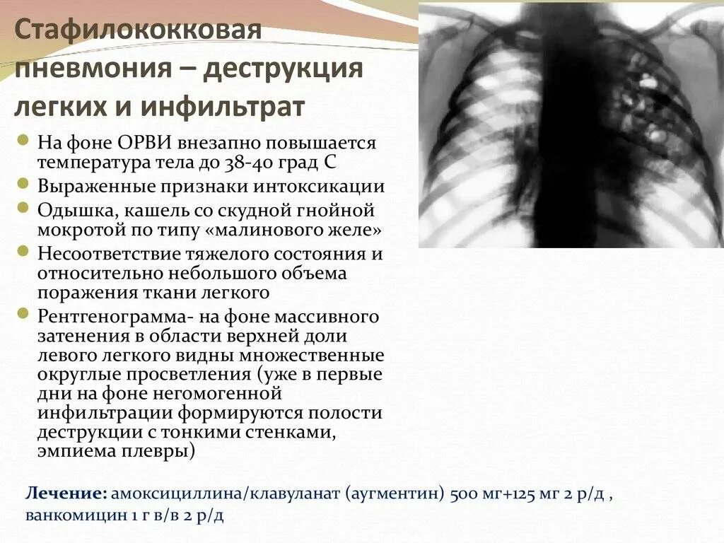 Стафилококковая пневмония кт. Стафилококковая пневмония терапия. Воспаление легких без температуры признаки у взрослого