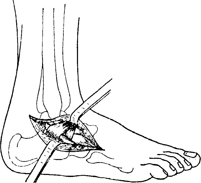 Артродез суставов операция. Пункция и артротомия голеностопного сустава. Пункция пункция голеностопного сустава. Артродез пяточно-кубовидного сустава. Операция Грайса подтаранный артродез.