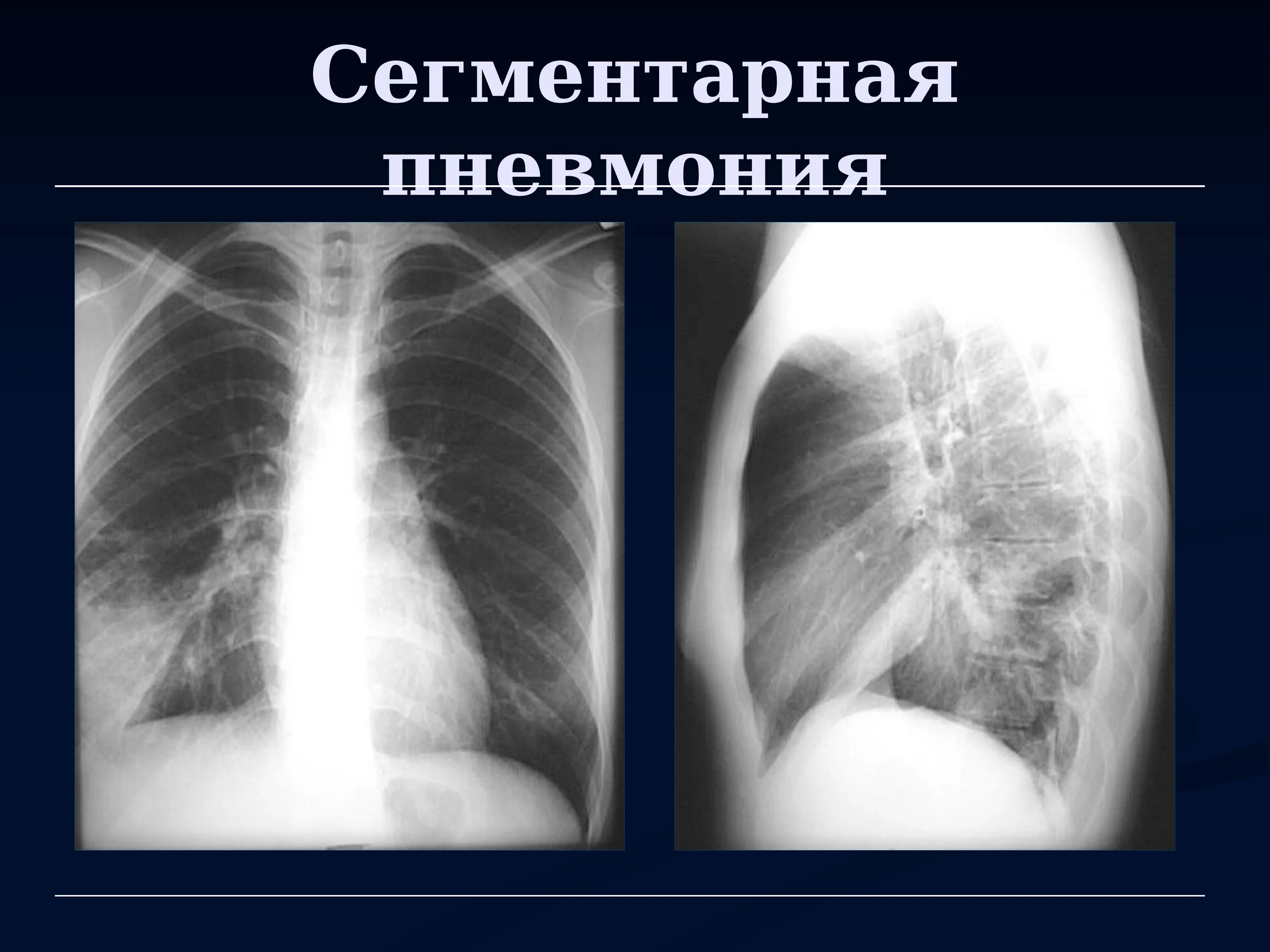 Сегментарная пневмония на Рент. Пневмония правосторонняя s4 s5. Сегментарная и крупозная пневмония. Сегментарная пневмония на ренгтен.