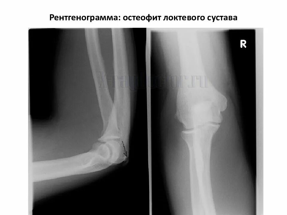 Суставная щель 3 3 мм