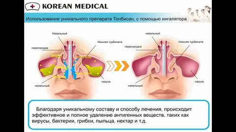 Аллергический синусит