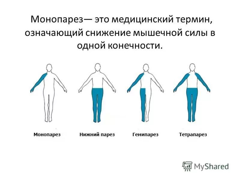 Моноплегия и монопарез. Гемипарез монопарез. Периферический монопарез верхней конечности. Правосторонний монопарез. Гемипарез лечение