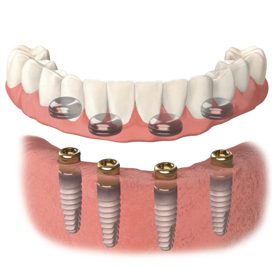 Имплантация Neodent. Несъемный мостовидный протез с опорой на 4 имплантата. Несъемные зубные протезы на 4 имплантах. Кнопочный протез на локаторах на 4 имплантах. Как крепятся съемные