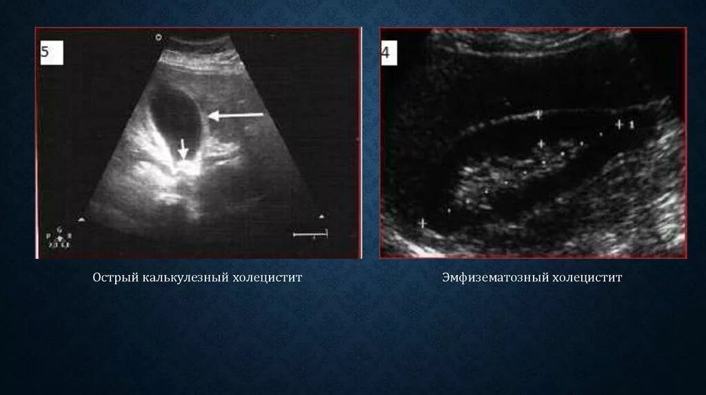 калькулезный холецистит приступ