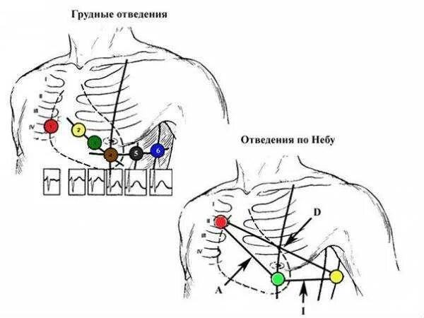 Электроды ЭКГ схема наложения электродов. Холтер ЭКГ схема наложения электродов. Отведения ЭКГ наложение электродов. Наложение электродов при ЭКГ схема наложения. Правые грудные отведения