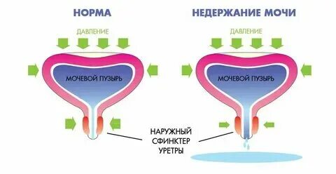 Стрессовое недержание мочи классификация. Недержание мочи у женщин что попить. Частые и болезненные позывы к мочеиспусканию. Профилактика недержания мочи у женщин. Энурез у ребенка 5 лет как лечить.