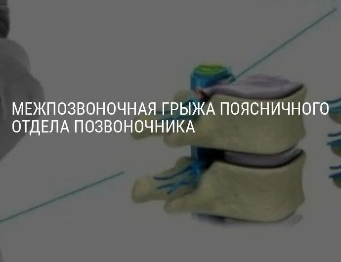 Восстановление после операции на грыжу позвоночника. Удаление межпозвоночной грыжи поясничного отдела позвоночника. межпозвоночная грыжа поясничного отдела лечение. межпозвоночная грыжа поясничного отдела отдает в ногу. витафон позвоночная грыжа поясничного отдела.
