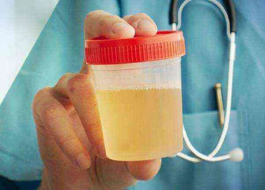 Белок в моче. Анализ мочи цвет. Норма мочи у беременной. Мутная моча при. Нормальный цвет мочи.