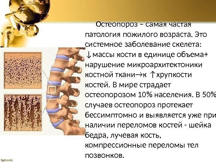 Болезнь костей остеопороз. Остеопороз позвоночника. Остеопороз позвонка. Клиническая картина остеопороза. Признак возрастных изменений костей