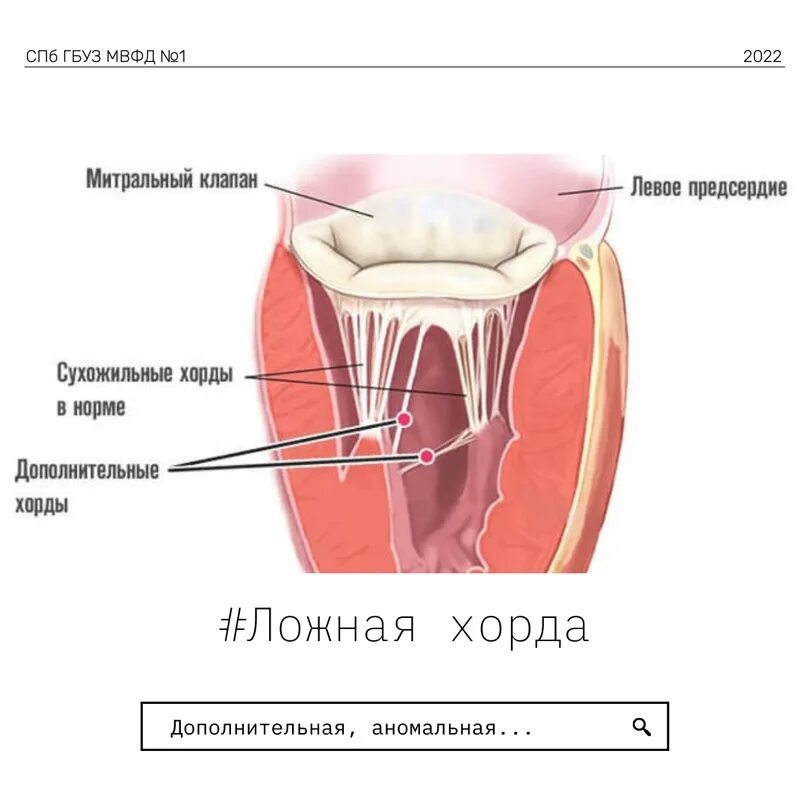 Дополнительные хорды левого желудочка что это такое. Дополнительные хорды левого желудочка что это такое. Дополнительная хорда левого желудочка. Ложная хорда левого желудочк. Дополнительная хорда левого желудочка.