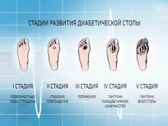 На начальных этапах хорошо. Диабетическая стопа гангрена. При диабетической стопе. Гангрена на ноге начальная стадия.