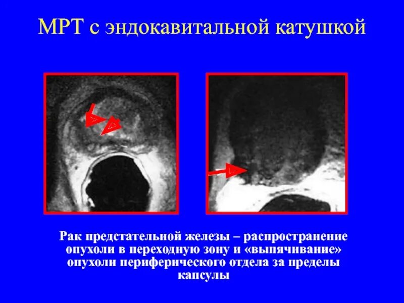 Аденома простаты мрт. Карцинома мрт предстательной железы. Опухоли предстательной железы мрт.