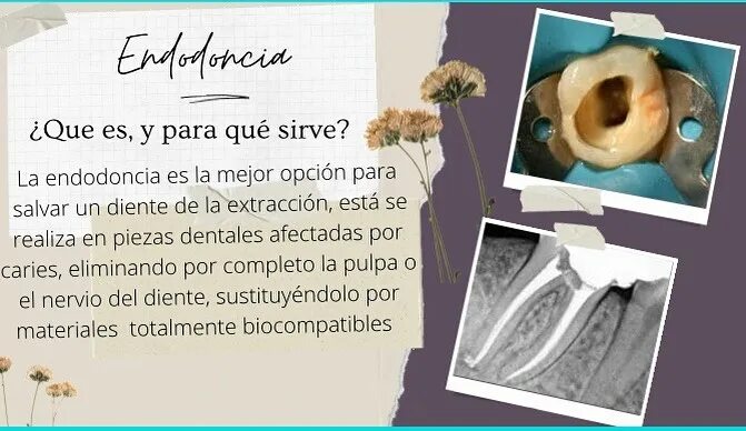 Que significa endodoncia