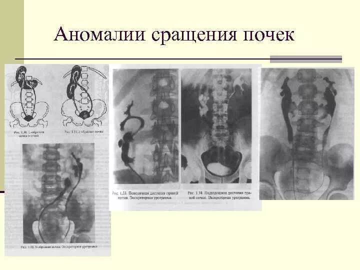 Аномалии развития мочеполовой. Аномалии развития почек сращение. Аномалии взаимоотношения - сращение почек. Аномалии мочеполовой системы. Аномалии развития мочевыделительной системы.