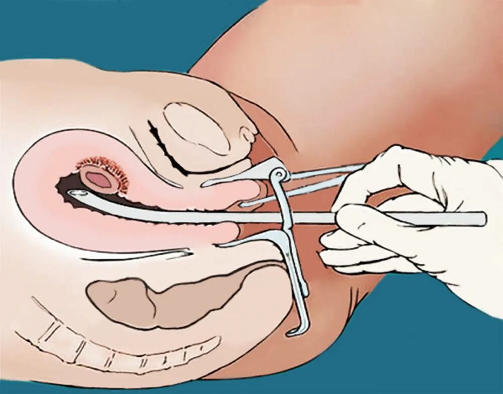 Выскабливание матки беременность. Вакуум аспирация аборт. Вакуумная аспирация матки аборт.