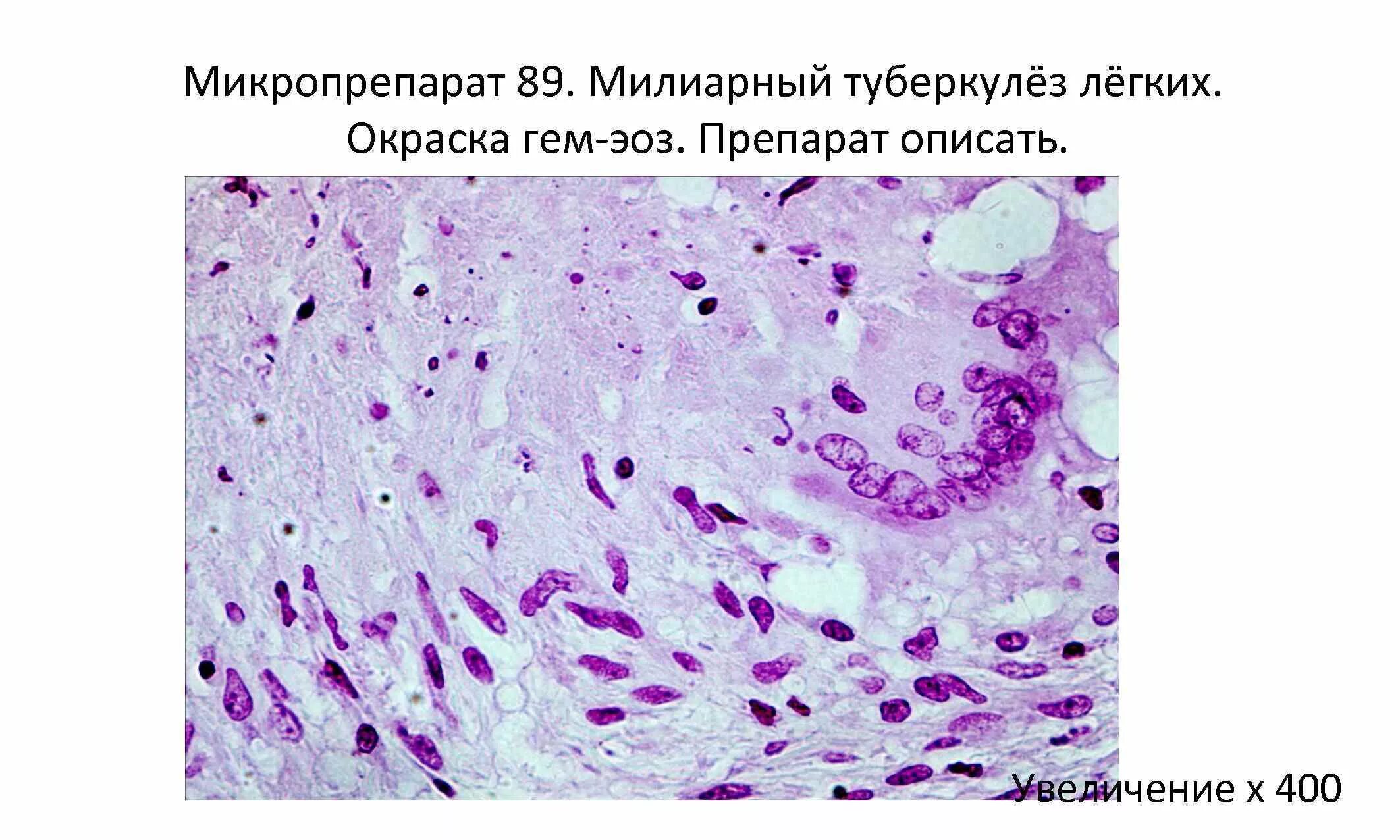 Милиарный туберкулез легкого препарат. Милиарный туберкулез гистология. Милиарный туберкулез макропрепарат. Диссеминированный туберкулез гистология. Пиелонефрит микропрепарат