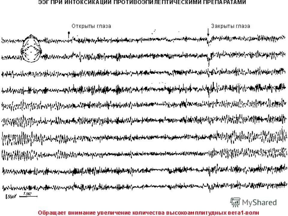 Вертексные потенциалы на ЭЭГ. Миоклонический приступ на ЭЭГ. Смерть мозга на ЭЭГ. Помехи на ЭЭГ. Записаться на ээг