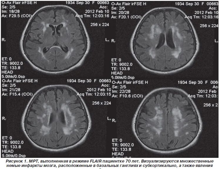 Лакунарный инсульт кт. Лакунарный инсульт на мрт головного мозга. Лакунарный инфаркт мозга мрт. Лакунарный ишемический инсульт головного мозга мрт. Множественные очаговые изменения головного мозга