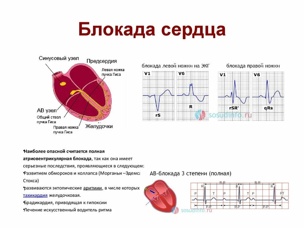 Блокада правой ножки желудочка. Блокада левого желудочка на ЭКГ. Блокада правого предсердия на ЭКГ. Блокада желудочков на ЭКГ. Блокада левого предсердия на ЭКГ.