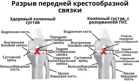 Выпот в полости коленного сустава. Крестовидная связка коленного сустава. Крестообразная связка коленного сустава. Отрыв крестообразных связок коленного сустава рентген. Рентген крестообразной связки коленного сустава.