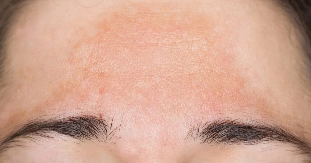 Мелазма пигментные пятна. Кислоты от пигментных пятен. Пилинги на основе койевой кислоты. Уколы от пигментных пятен. Кислоты от пигментных пятен.