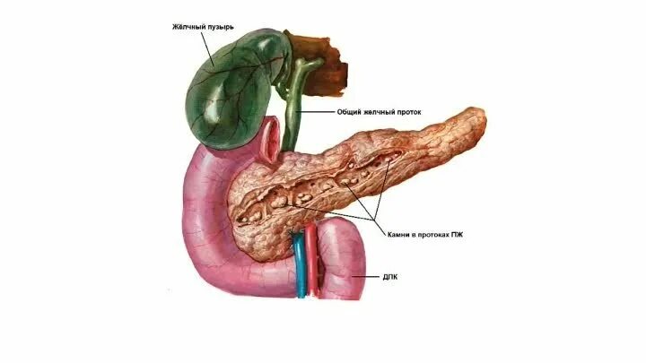 Панкреатит при удаленном желчном. Камни в поджелудочной фото. Строение протоков поджелудочной железы и желчного пузыря. Гигантский желчный пузырь.