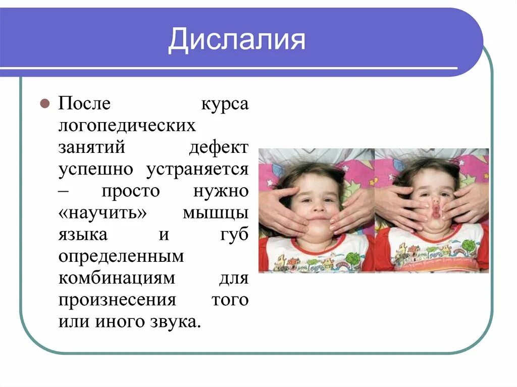 Определение дислалии. Дислалия. Дислалия у детей. Дислалия у детей дошкольного возраста. Занятия с ребенком дислалия.