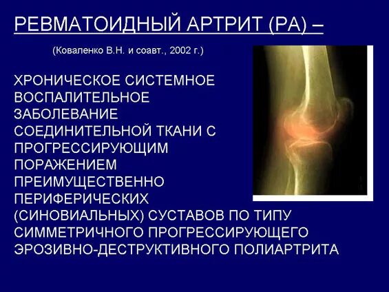 Клинические проявления ревматического артрита. Суставная форма ревматоидного артрита. Осложнения ревматоидного артрита. Ревматоидный артрит суставная форма жалобы. Ревматические осложнения