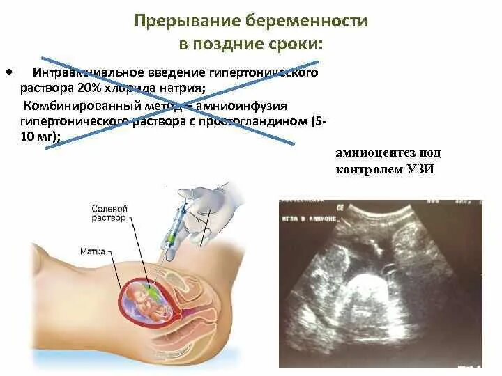 До какой неделе делают прерывание. Рерывани ебрееменности. Прерывание беременности. Прерывание беременности на ранних сроках. Медикаментозное прерывание беременности на поздних сроках.