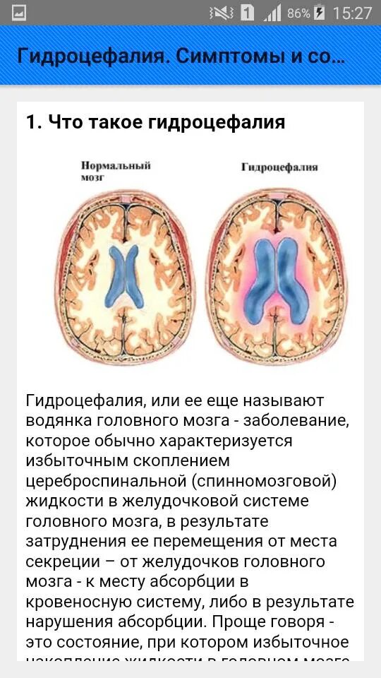 Выраженная заместительная гидроцефалия. Внутренняя и внешняя гидроцефалия. Смешанная заместительная гидроцефалия.