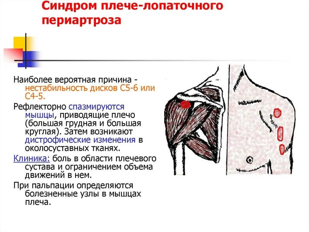 Лопаточный периартроз плечевого сустава. Синдром плечелопаточный периартрит. Плече-лопаточный синдром. Заболевания плечевого мышц и сустава. После операции болят плечи