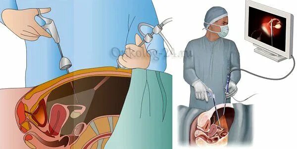 Лапароскопия матки отзывы. Миомэктомия матки миомэктомия. Лапароскопическая операция на миому. Лапароскопия консервативная миомэктомия.