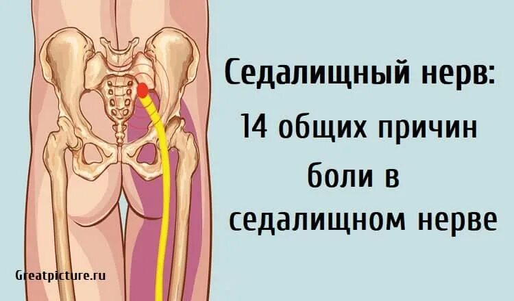 Седалищный нерв. Седалищный нерв симптомы. Боль в седалищном нерве.