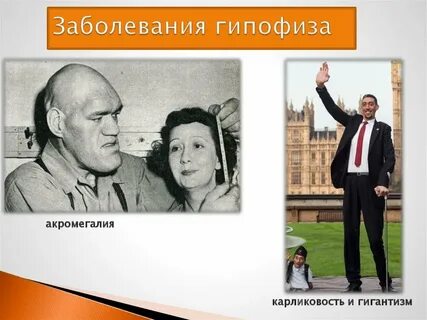 Карликовость гигантизм акромегалия