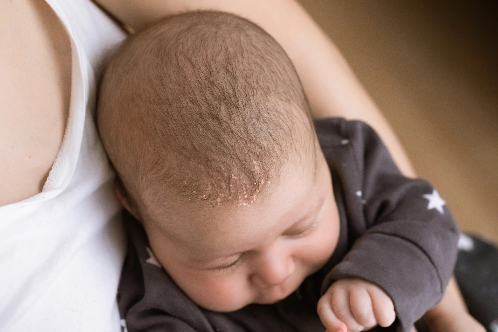 Месячные на лоб. Себорейный дерматит у новорожденных. Корочки на голове у ребенка. Себорейная корочка у младенцев.