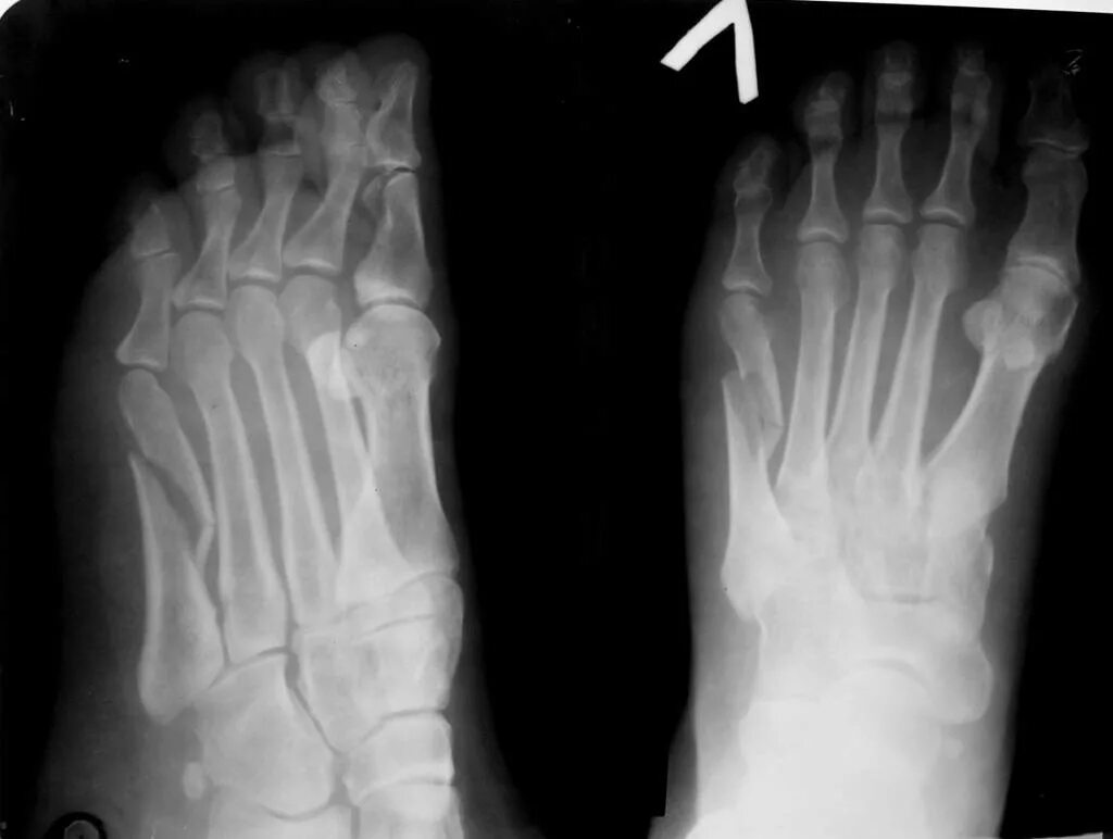 диафизарный перелом лучевой кости. перелом локтевой кости у собаки рентген. 2 перелом со смещением. переломовывих галеацци остеосинтез. 2 перелом со смещением.