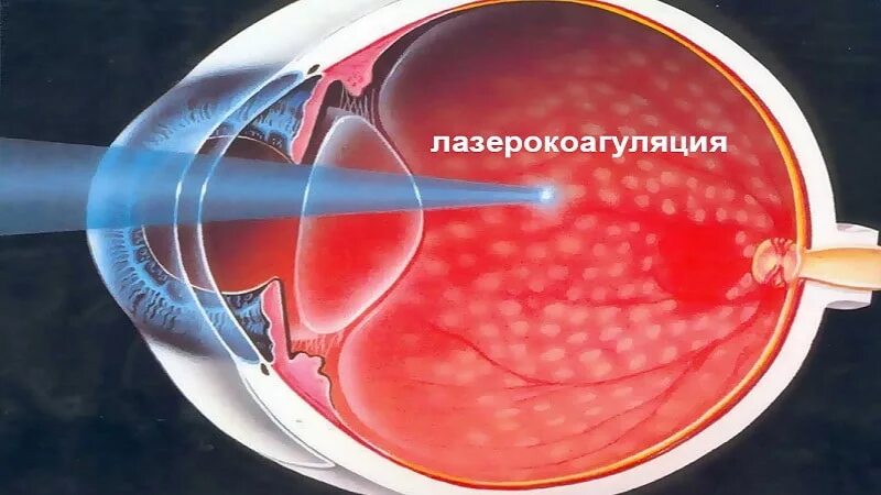 Периферическая лазеркоагуляция сетчатки. Отслойка сетчатки лазеркоагуляция. Периферическая лазеркоагуляция сетчатки ППЛК. Ретинопатия недоношенных лазеркоагуляция.