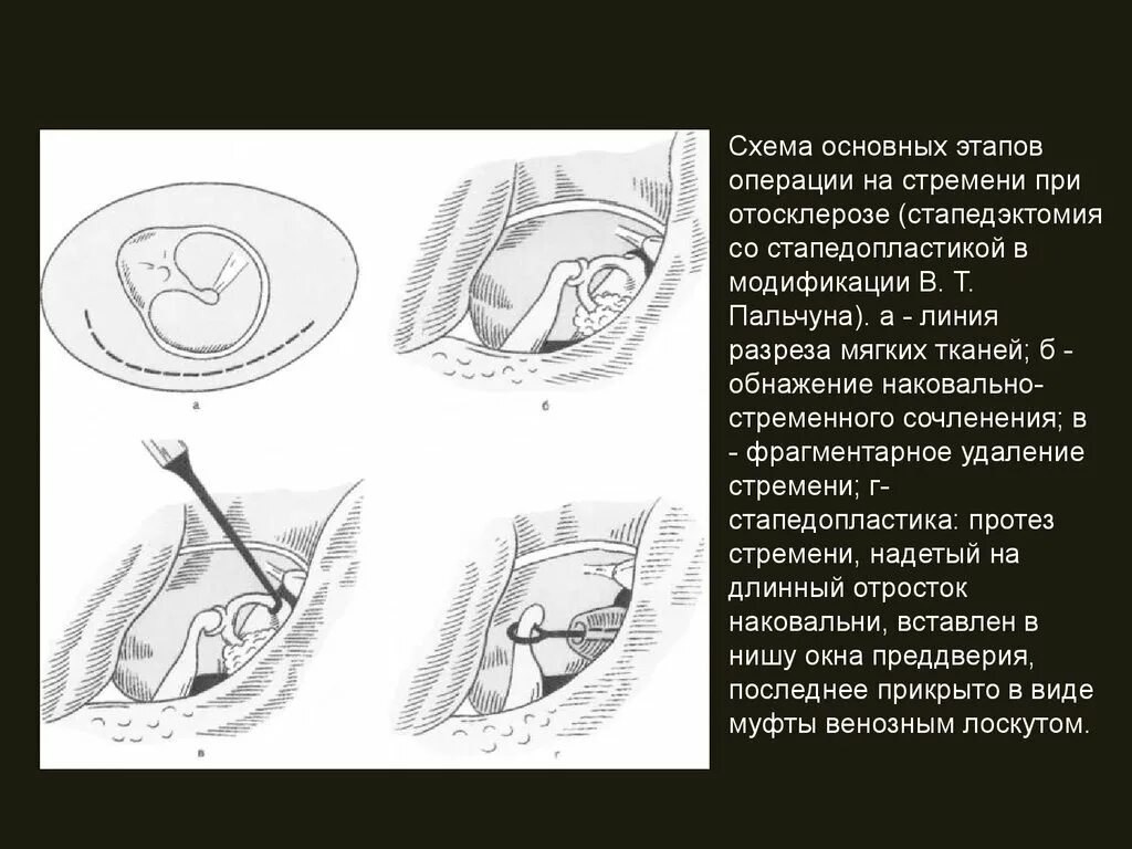 Отосклероз уха операция. Операция стапедопластика при отосклерозе. Стапедопластика этапы операции. Операция при отосклерозе уха. Стапедэктомия при отосклерозе.